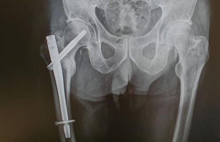 Radiografia de l'operació d'en Manel arran de l'atropellament d'un patinet elèctric. FOTO: Cedida