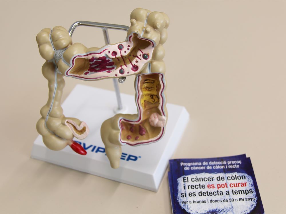 El càncer de colon i recte representa la segona causa de mort per càncer. FOTO: Parc Taulí