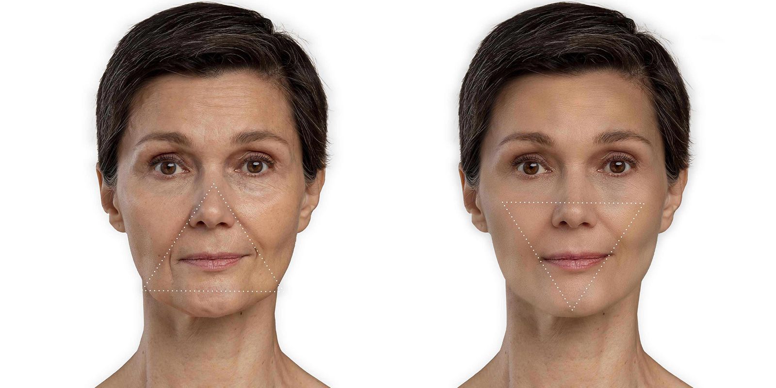 Una abans i un després en una intervenció del triangle de la bellesa FOTO: Cedida